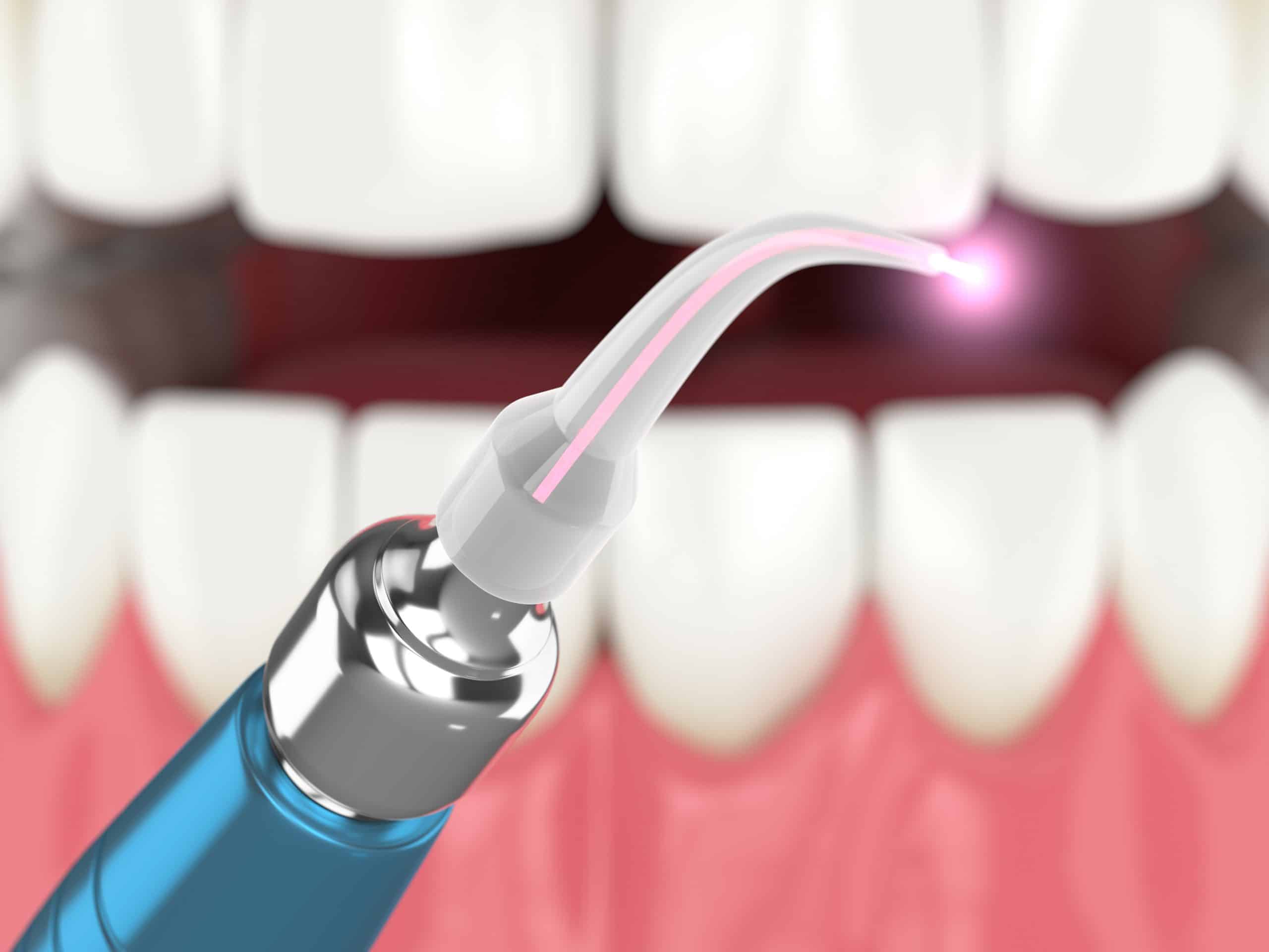 Laser Treatment in Periodontal Therapy