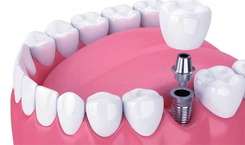 Medical Conditions And Dental Implants: What You Need To Know